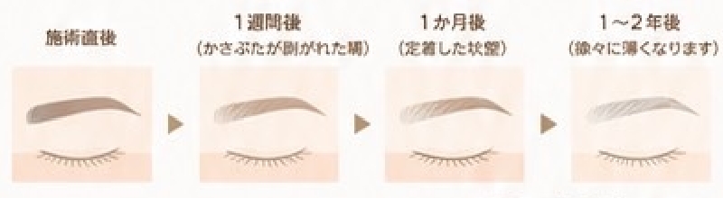 眉の経過イメージ：施術直後、1週間後（かさぶたが剥がれた眉）、1か月後（定着した状態）、1〜2年後（徐々に薄くなります）